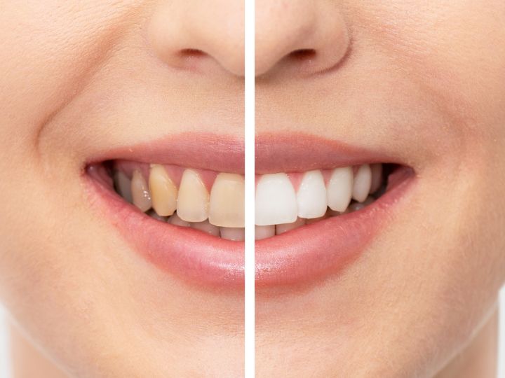 Blanqueamiento dental beneficios
