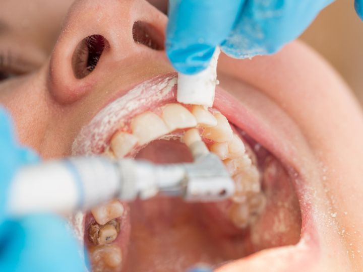 Todo lo que debes saber sobre la limpieza dental