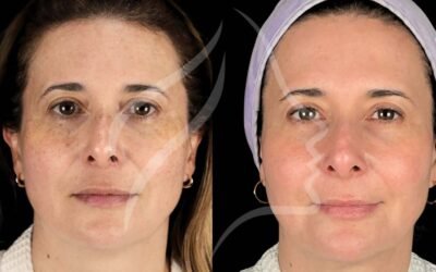 Cosmelan peel